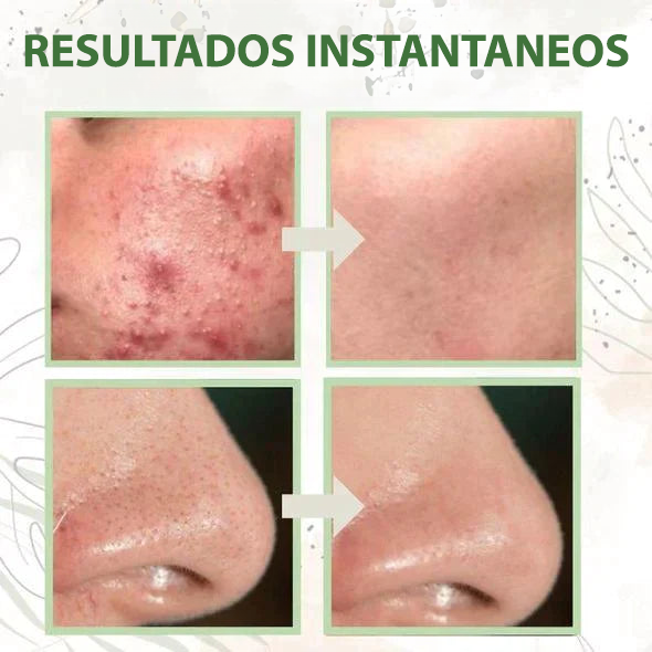 NO MÁS PUNTOS NEGROS: Máscara Té Verde Natural